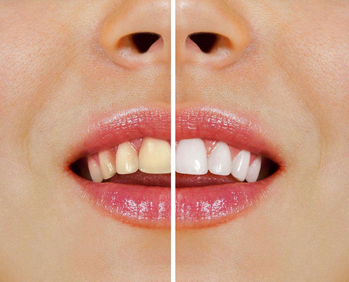 Essential Guide for Teeth Whitening