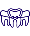 Dental Braces